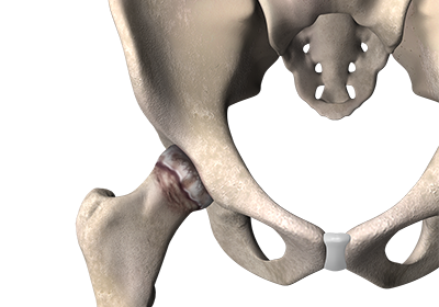diseased-hip Diseased Hip